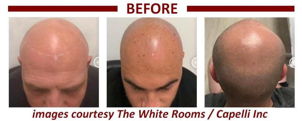 three-men-photographed-before-scalp-micropigmentation-hair-loss-treatment