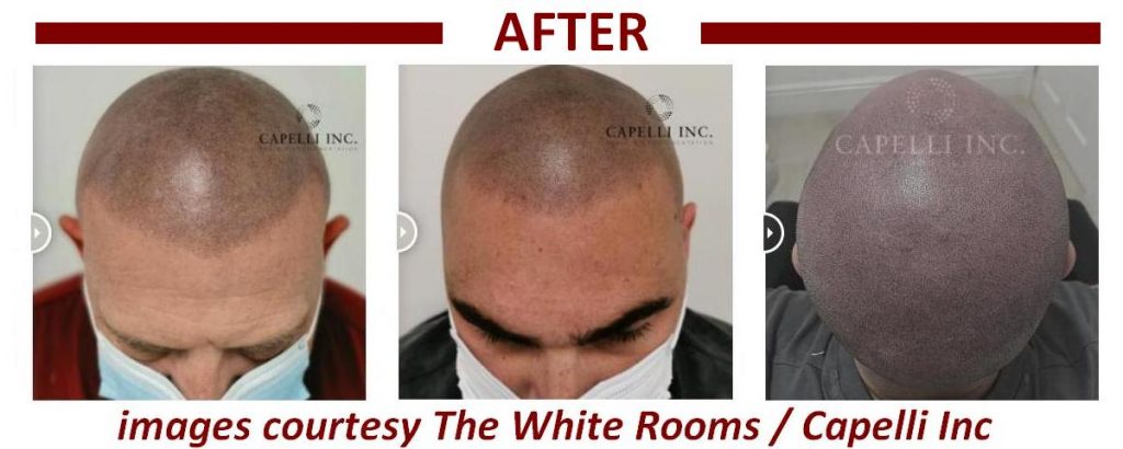 three-men-photographed-after-scalp-micropigmentation-hair-loss-treatment